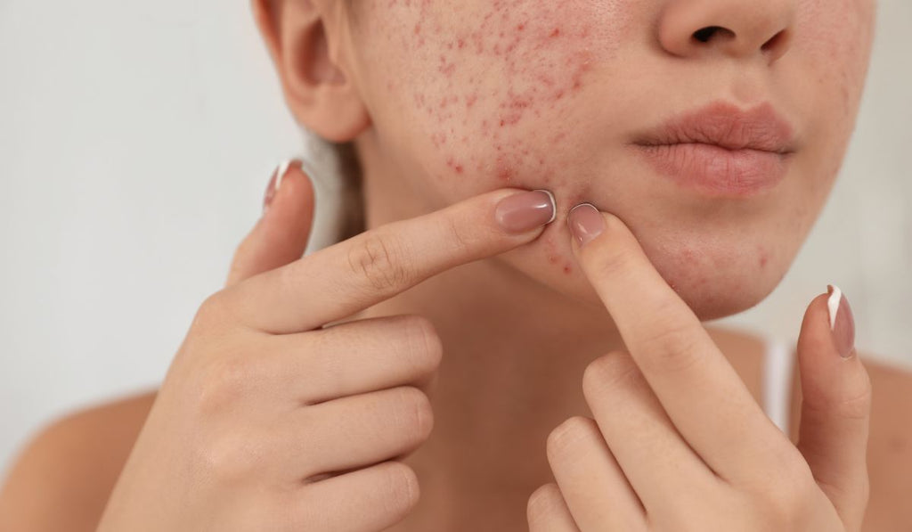 Pimples, to pop or not to pop?